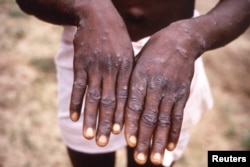 An image from an investigation into an outbreak of monkeypox, which took place in the Democratic Republic of the Congo (DRC), 1996 to 1997, shows the hands of a patient with a rash due to monkeypox. (CDC/Brian W.J. Mahy/Handout via REUTERS)