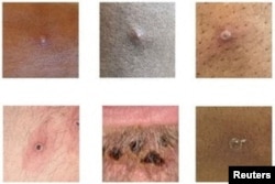 Pictures showing examples of rashes and lesions caused by the monkeypox virus are seen in this undated handout image obtained by Reuters on July 1, 2022. (UK Health Security Agency/Handout via REUTERS)
