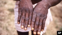 This 1997 image provided by the CDC during an investigation into an outbreak of monkeypox, which took place in the Democratic Republic of the Congo (DRC), formerly Zaire, and depicts the dorsal surfaces of the hands of a monkeypox case patient.