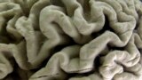 FILE - A closeup of a human brain affected by Alzheimer's disease, is displayed at the Museum of Neuroanatomy at the University at Buffalo in Buffalo, New York, in 2003. (AP Photo/David Duprey)