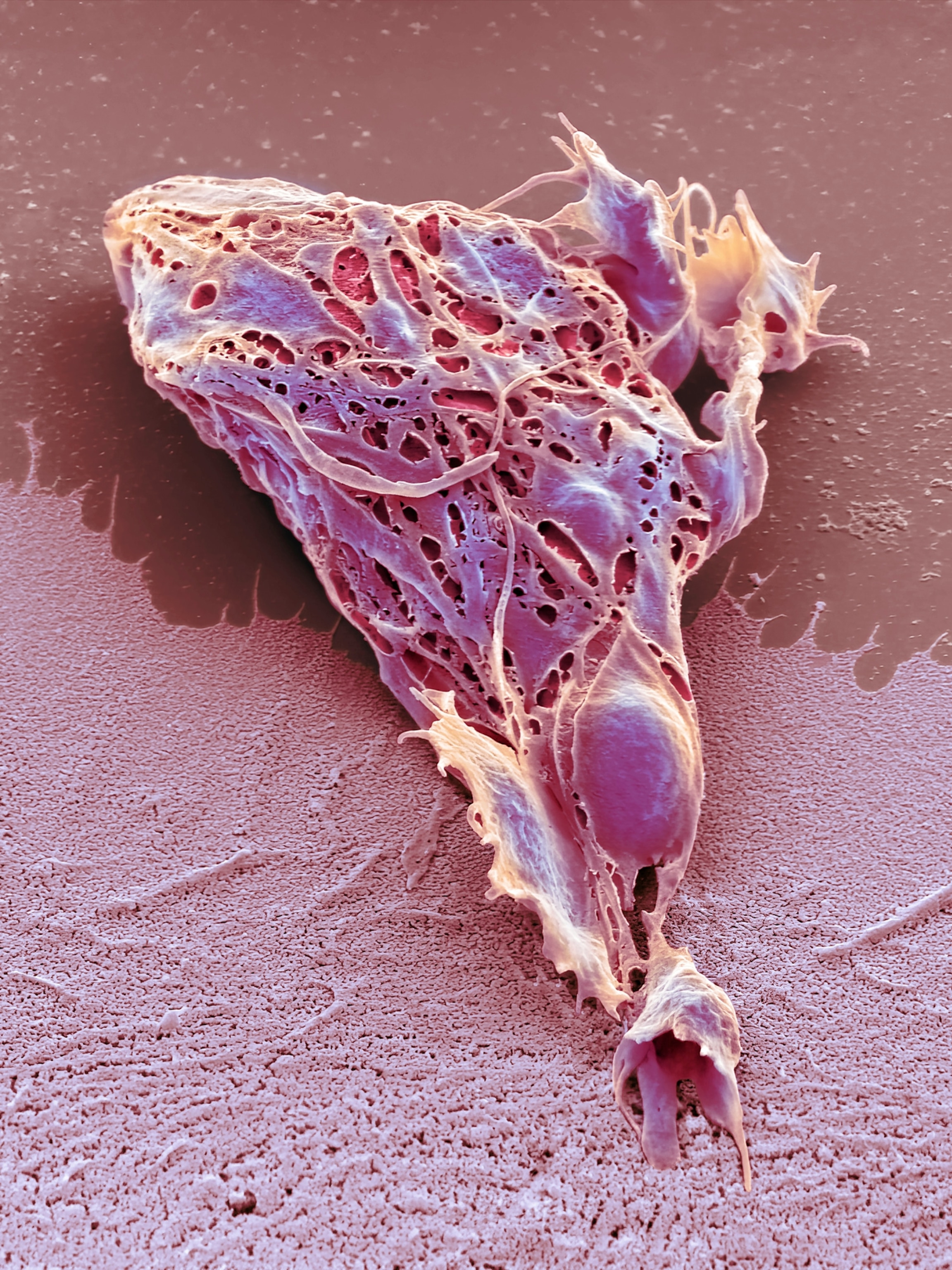 Chemotherapy induced cell death. Coloured scanning electron micrograph (SEM) of a cultured cancer cell (HeLa) treated with doxorubicin to cause necrosis.