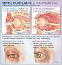 Periorbital and Orbital Cellulitis