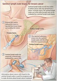 Lymphatic Mapping and Sentinel Lymph Node Biopsy for Breast Cancer  JAMA Oncol. Published online November 22, 2017. doi:10.1001/jamaoncol.2017.4000