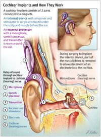 Cochlear Implant Surgery