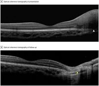 Optical Coherence Tomography Monitoring in a Patient With Retinoblastoma