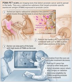 PSMA PET Scan Medical Illustrations, Prostate Cancer, Pet Scan, Membrane, Neuroscience, Medical Illustration