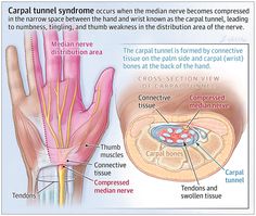 What Is Carpal Tunnel Syndrome? Carpal Tunnel Syndrome, Median Nerve, Carpal Tunnel, Med Surg Nursing, Musculoskeletal System, Hand Reflexology, Medical Surgical Nursing, Carpel Tunnel Syndrome