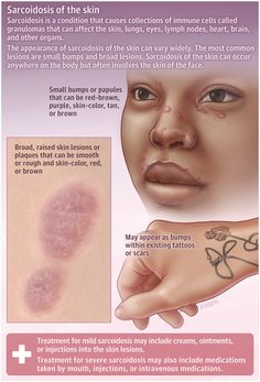 Sarcoidosis of the Skin Human Body, Skin Diseases, Boys Aesthetic Outfits, Basic Anatomy And Physiology, Esthetics, Anatomy And Physiology