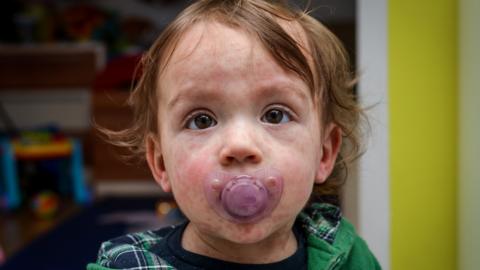 Child with measles