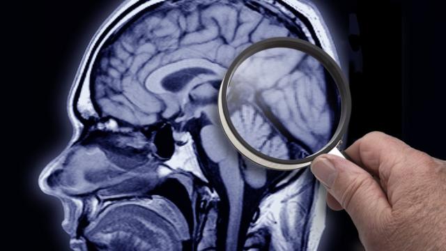 Изучение МРТ-снимка мозга через лупу