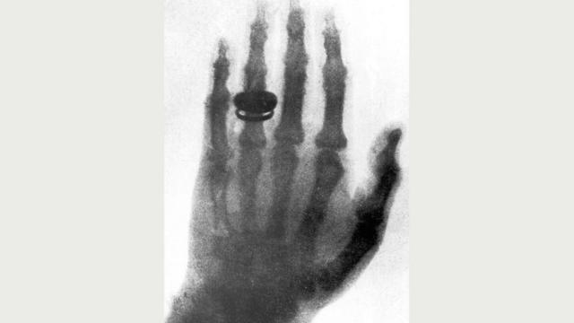 Открытие рентгеновских лучей в 1895 году стало международной сенсацией