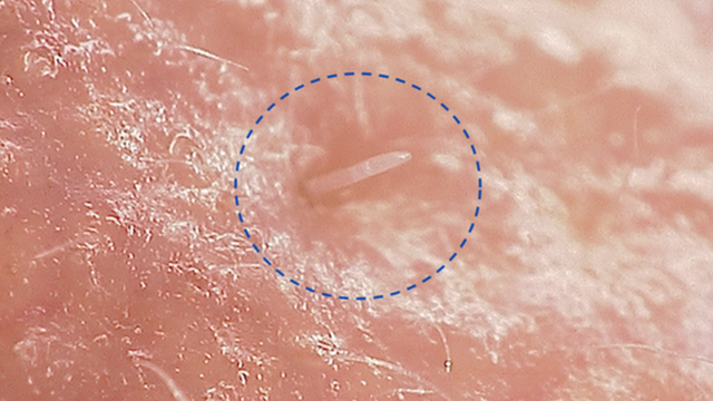 Demodex follicularum