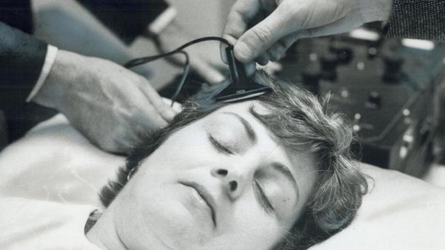 Врачи в больнице канадского города Торонто укрепляют электроды на голове пациентки во время имитации процедуры ЭСТ (1976 год)