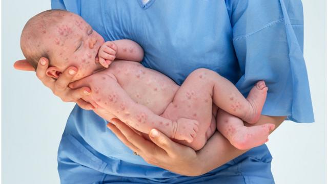 Baby with measles rash