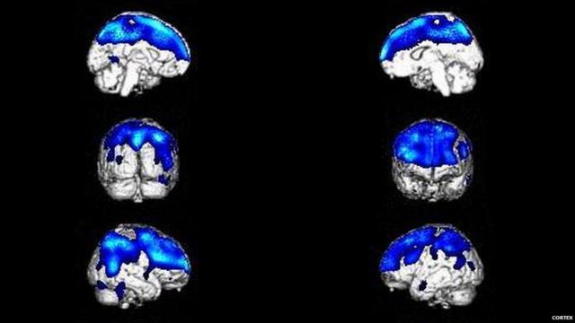 Мозг человека с синдромом Котарда