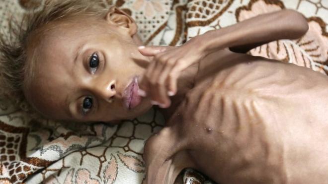 Голод в Йемене