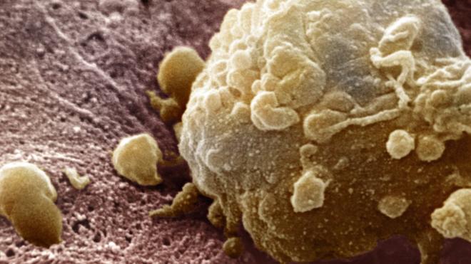The cells of a melanoma cancer