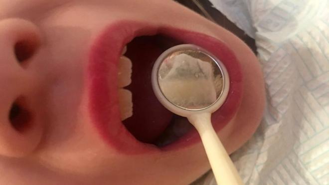 Раскрытый рот у зубного