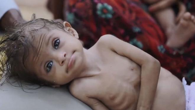 В Йемене от сильного истощения страдают 2 миллиона детей.