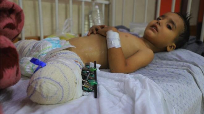 3歳のアフメド・シャバトちゃんは、ガザ地区での爆発で両足を失った