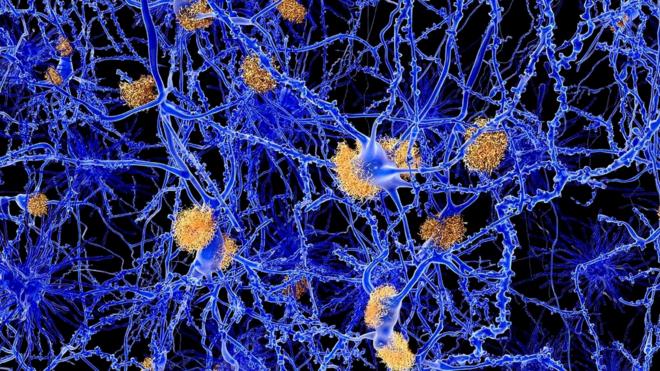 Что происходит в мозгу больного Альцгеймером?