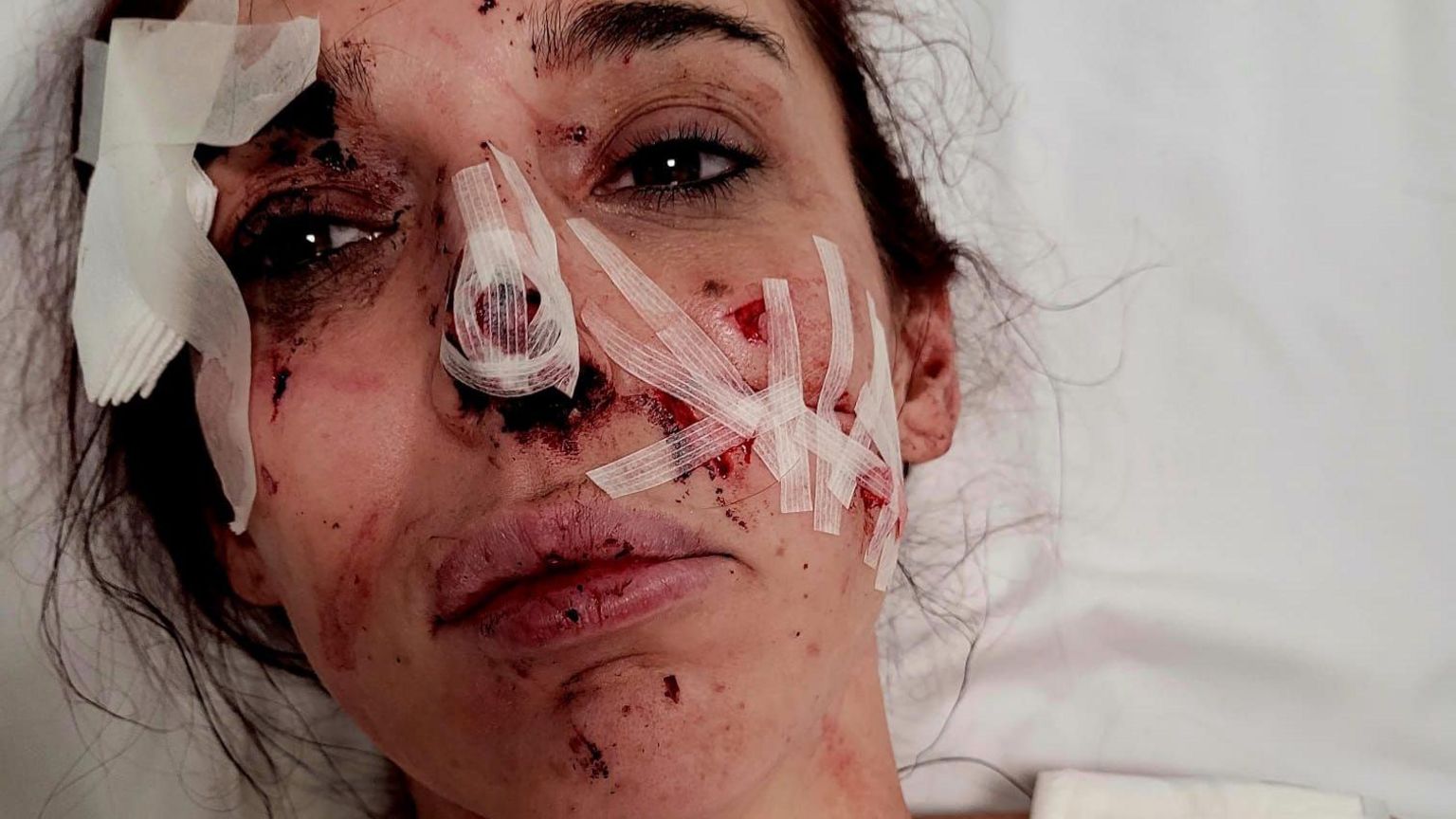 Natalie Arthurs with facial injuries after glass attack