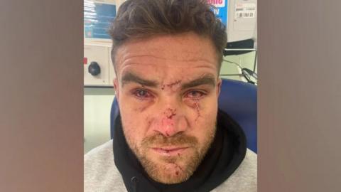 Matthew Syron's injuries after being attacked by Gareth Dean in a Leeds nightclub