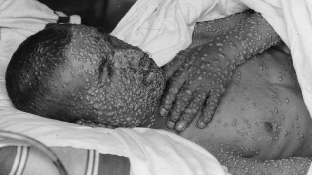 A boy with smallpox blisters al over his body