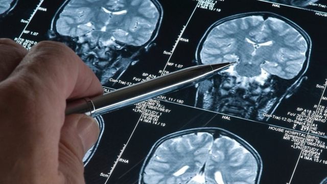 Ручка, указывающая на МРТ-снимок головного мозга