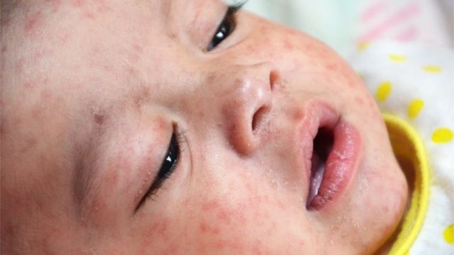 Measles. Close-up of a baby with a rash on its face caused by measles.