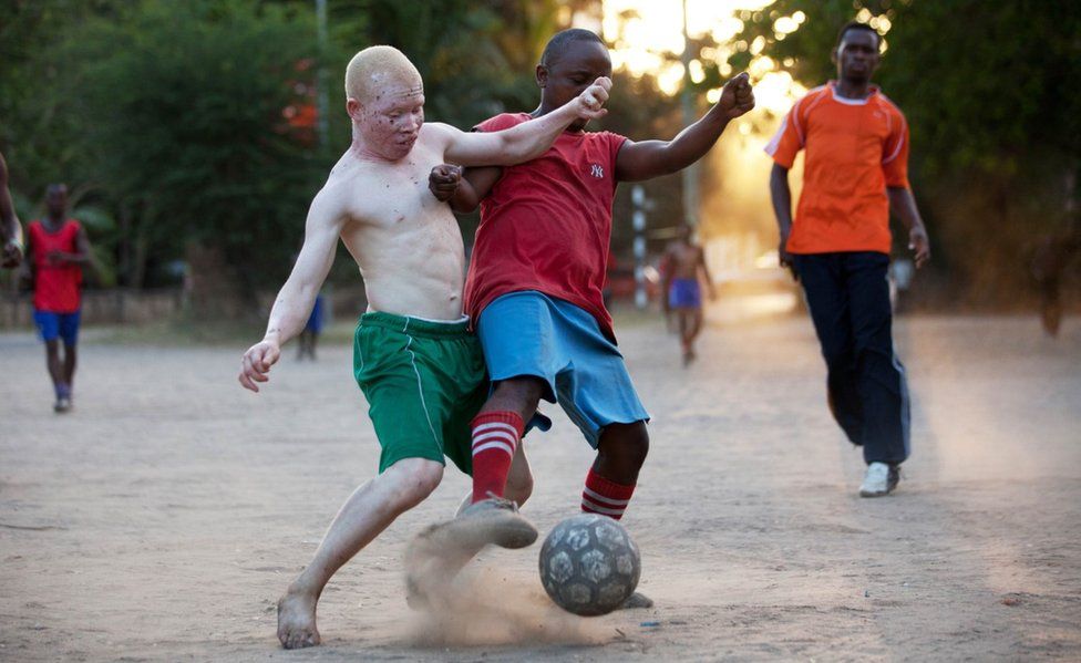 Albino boy playing football in Tanzania