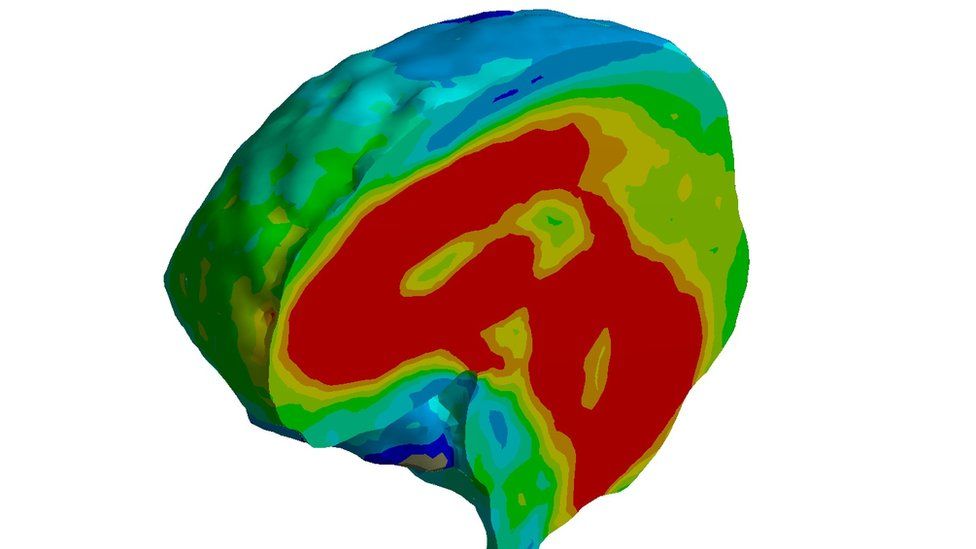 A picture of the brain 10 milliseconds after impact. High stress regions show up in red