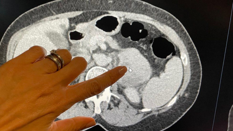 Tina's tumour is pointed out on a scan