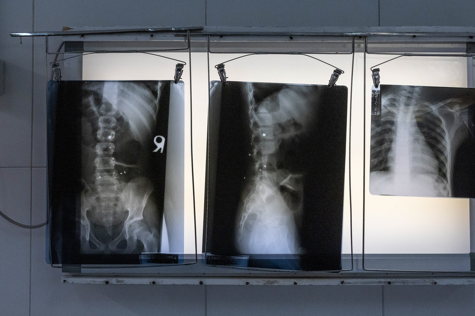 Both boys have bullet fragments inside them. Imran has a large fragment lodged in his spine. Image: Julian Busch/BBC