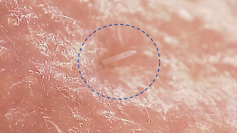 Demodex follicularum, the mite that lives in our face