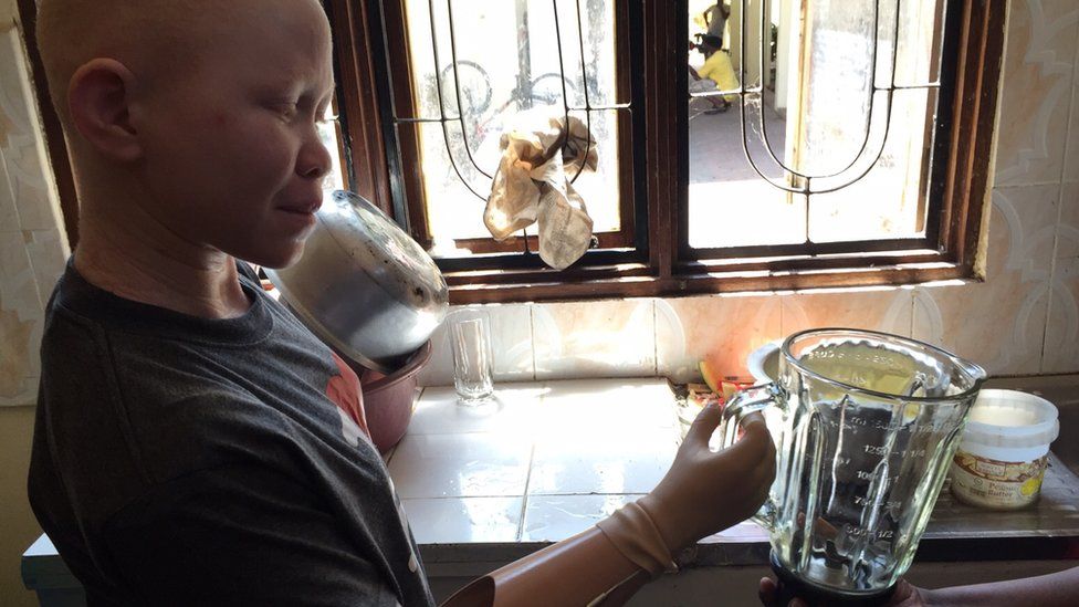 albino child with prosthetic limb lifts water jug