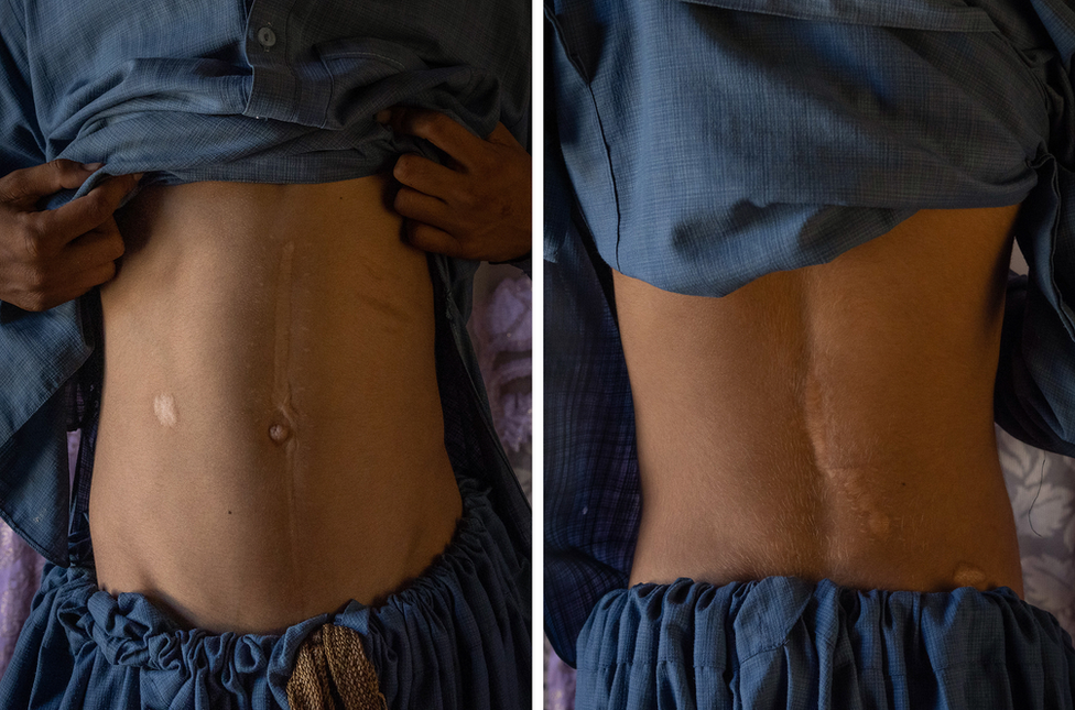 Scars on Imran's abdomen show the damage from the bullet wound as well as his surgical incision. Image: Julian Busch/BBC