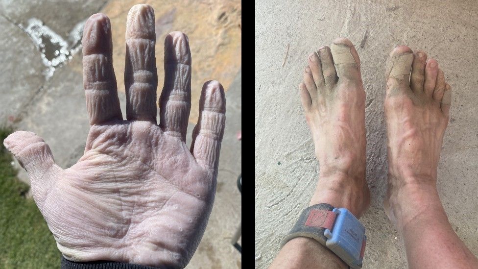 Stuart Gillett's hand, shrivelled from a 24 mile swim, and bandaged feet from cycling and running.