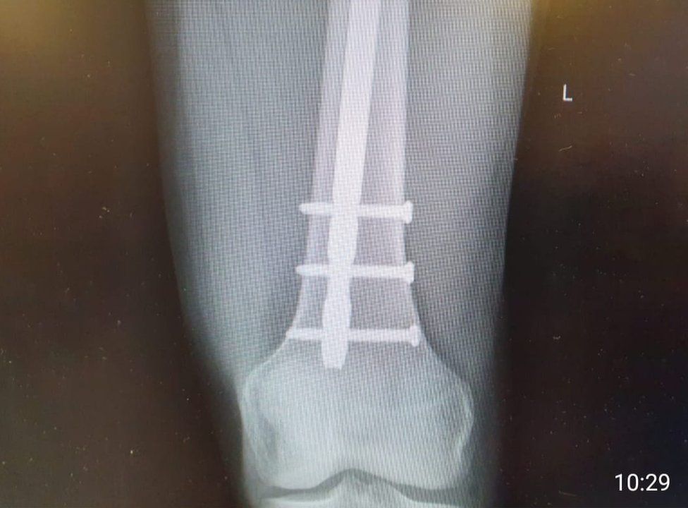 The X-ray showing the rod and screws in Neal Watson's leg