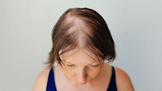Haarausfall: Ursprung, Symptome und Arten 