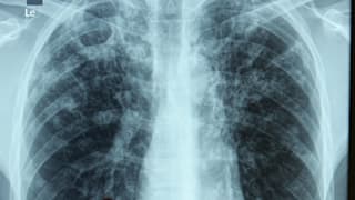 Tuberkulose: Symptome, Diagnose und Behandlung der Krankheit
