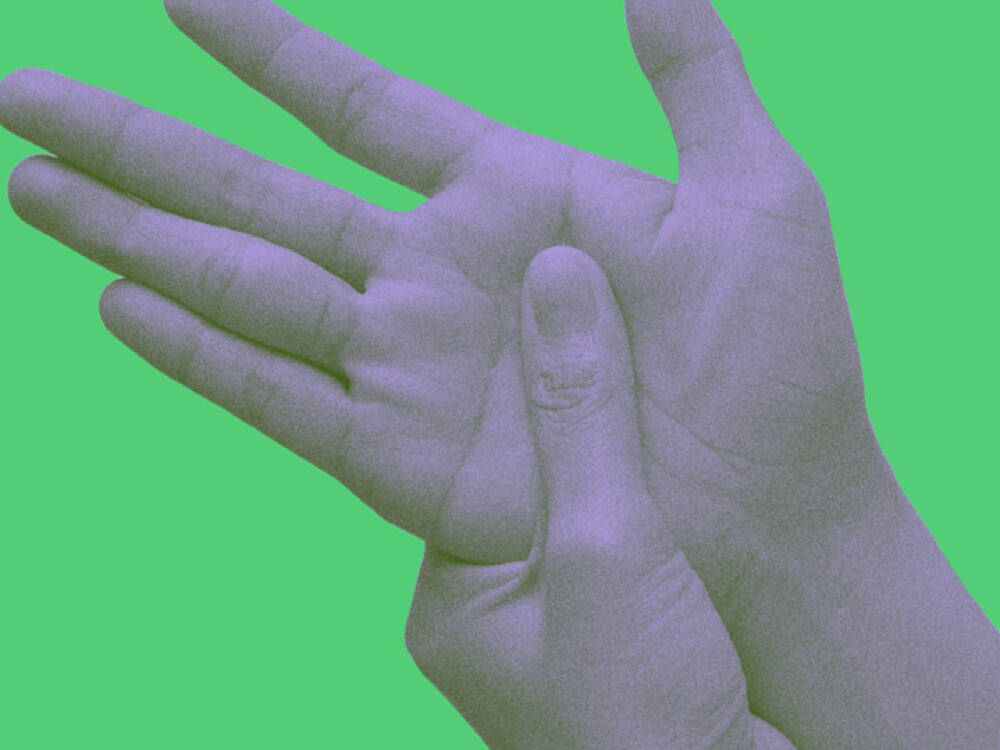 Rheumatoid Arthritis symptom on the hand