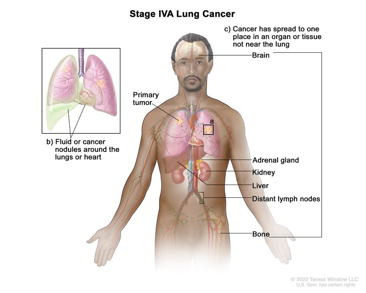 Stage IVA lung cancer; drawing shows a primary tumor in the right lung and (a) a tumor in the left lung. Also shown is (b) fluid or cancer nodules around the lungs or heart (inset), and (c) other organs or tissues where lung cancer may spread, including the brain, adrenal gland, kidney, liver, bone, and distant lymph nodes.