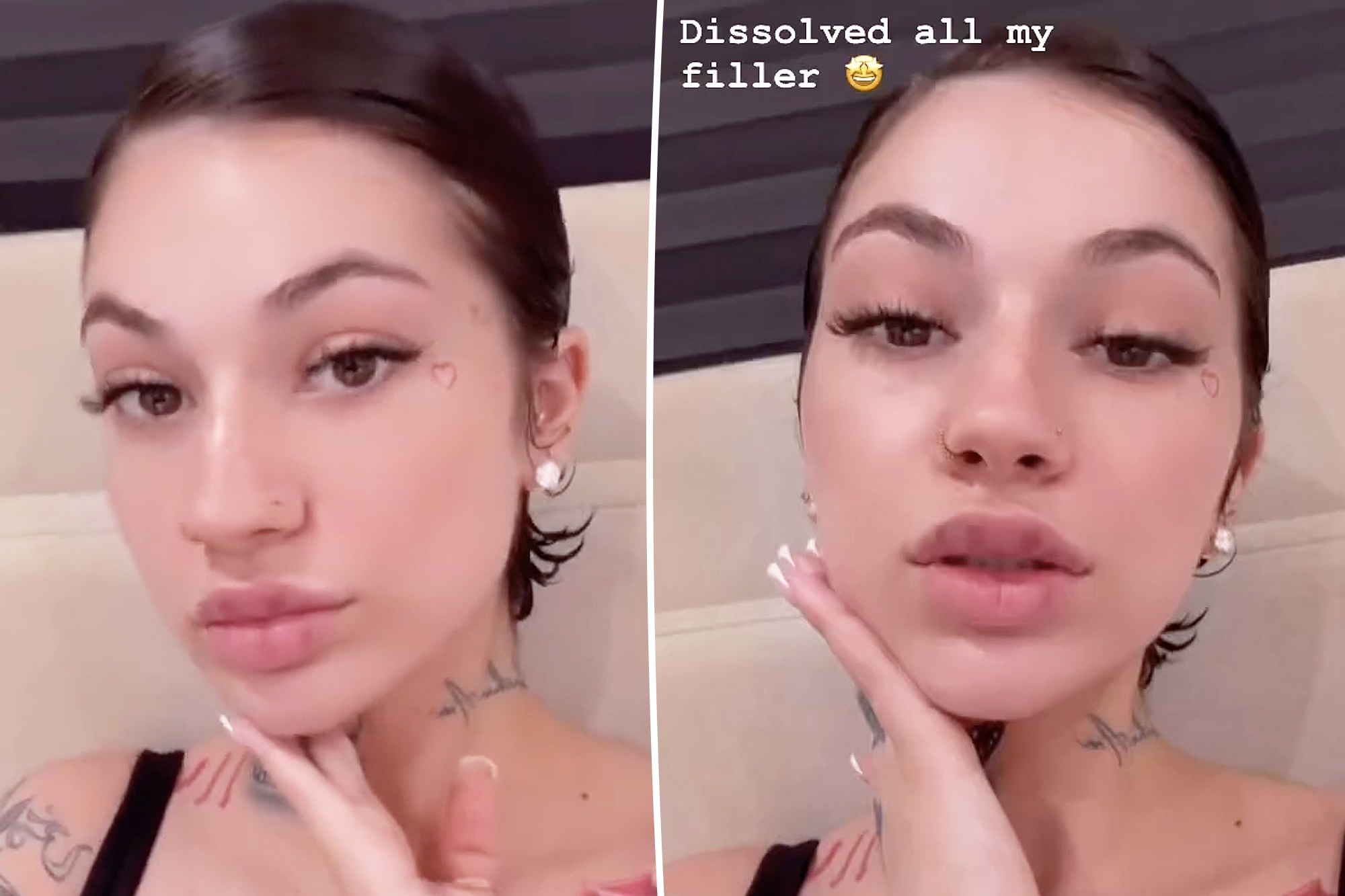 Bhad Bhabie dissolved her fillers, warns people to stop getting them
