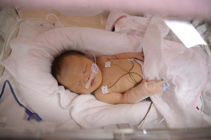 NICU Baby with down syndrome