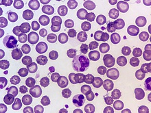 Canine distemper virus cytoplasmic inclusion body (blood smear, Wright's stain)