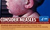 Consider Measles infographic