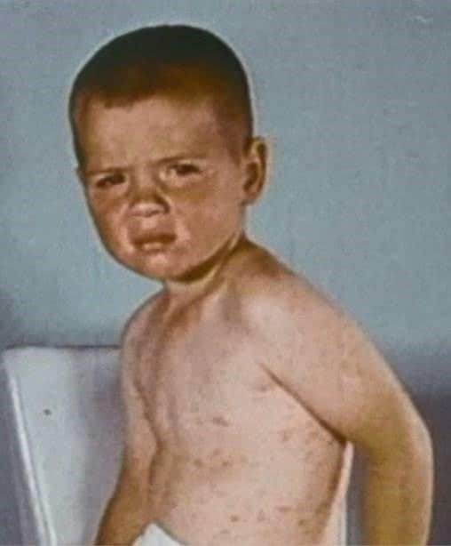 Young boy with rash on upper body from measles