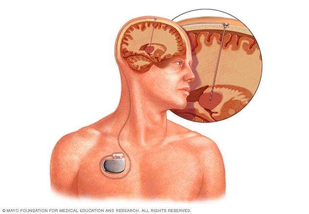 Deep brain stimulation