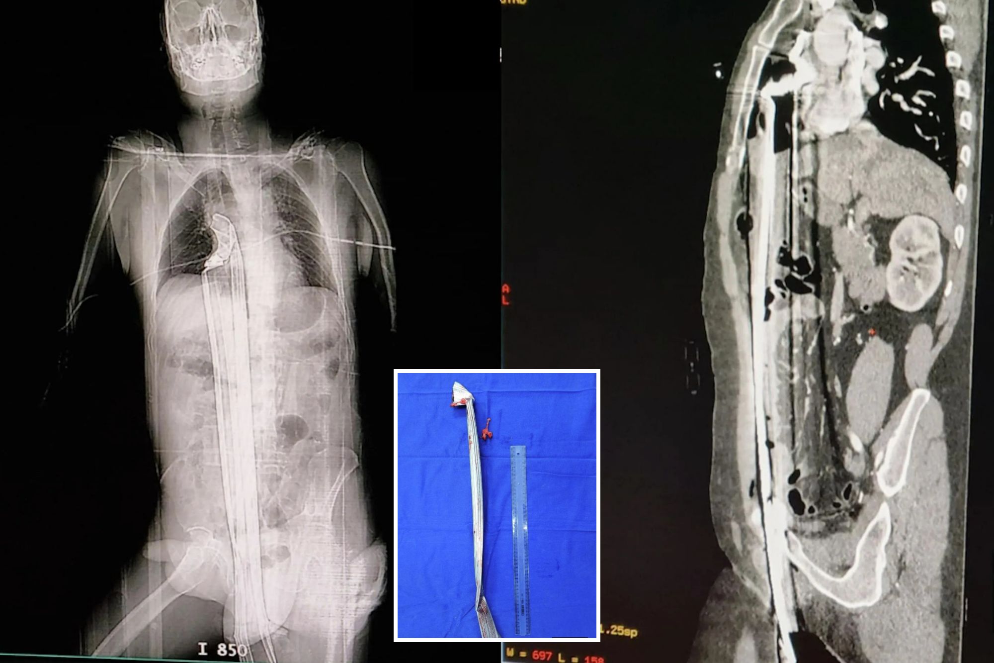 Man escapes death after iron rod shoots through groin & into chest after fall